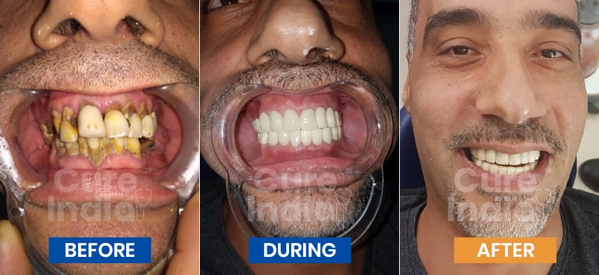 Full-Dental implants before and after Case 1